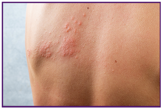 Shingles rash